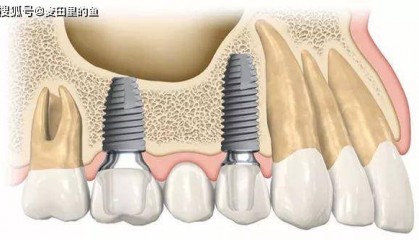 种植牙当天就可以种吗？
