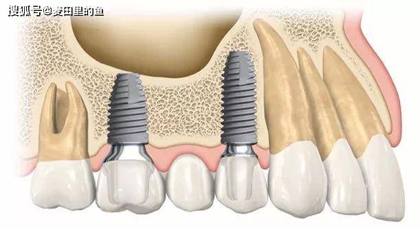 种植牙当天就可以种吗？